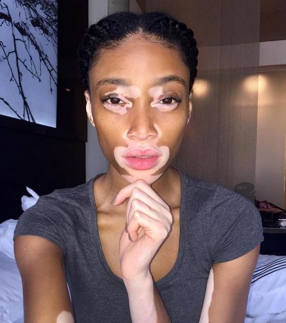 Winnie Harlow. Czarnoskóra modelka z bielactwem niesie przesłanie w świat: piękna szukaj w sobie!