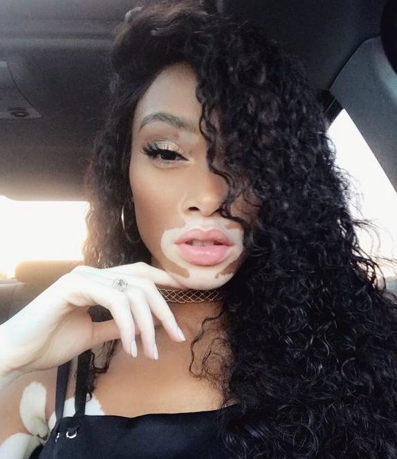 Winnie Harlow. Czarnoskóra modelka z bielactwem niesie przesłanie w świat: piękna szukaj w sobie!